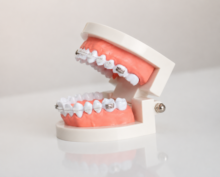 Dental model with braces used to explain orthodontic treatment