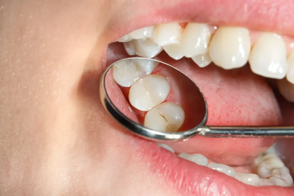 Close-up of a dental mirror reflecting a lower molar with a tooth-colored composite filling during a dental exam