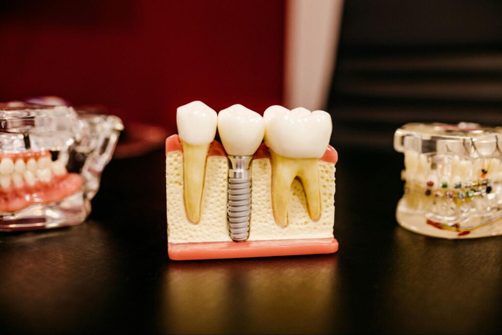 Pulpotomy care for kids and teens at Aurora TenderCare Dental