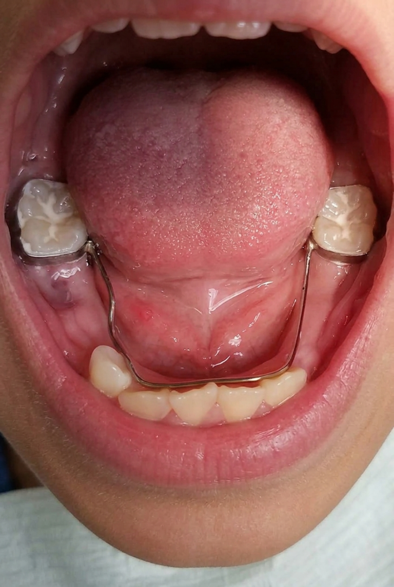 Space mSpace maintainer from a trusted children's dentist in Aurora, CO. aintainer from a trusted children's dentist in Aurora, CO.